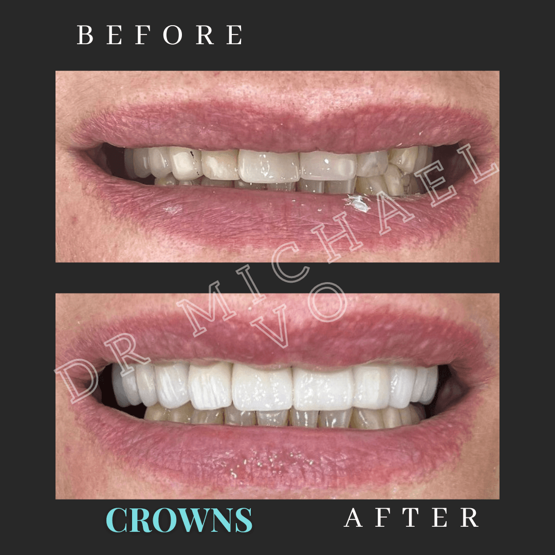 Crowns - West Island Dental Clinic