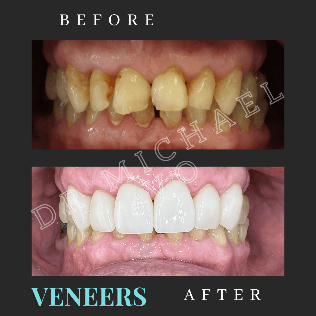 Veneers - West Island Dental Clinic